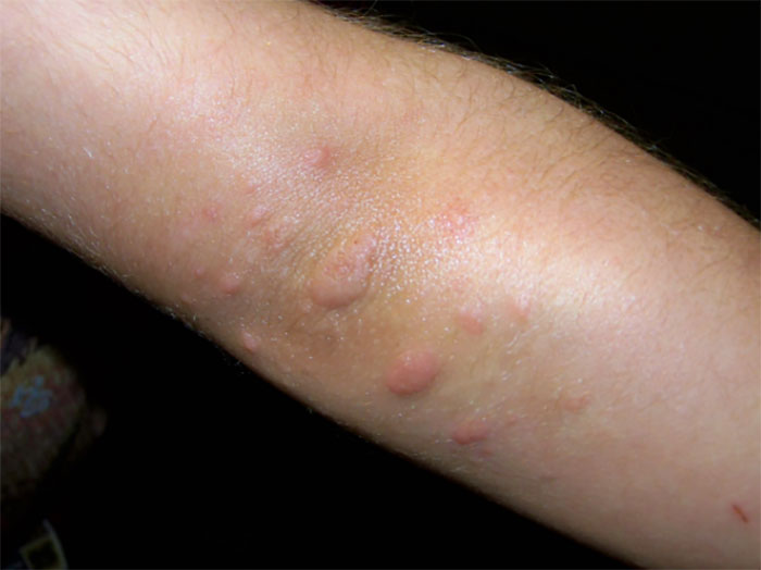 5. Kui teil tekib akne küünarnukkidele, siis võib see olla märk keratosis pilaris’est, kahjutust nahahaigusest, mida põhjustab keratiini kogunemine. Kuigi kuiv nahk kipub seda seisundit halvemaks muutma, siis võib selles piirkonnas paiknev akne olla ka märk ebapiisavast vitamiinide omastamisest.
