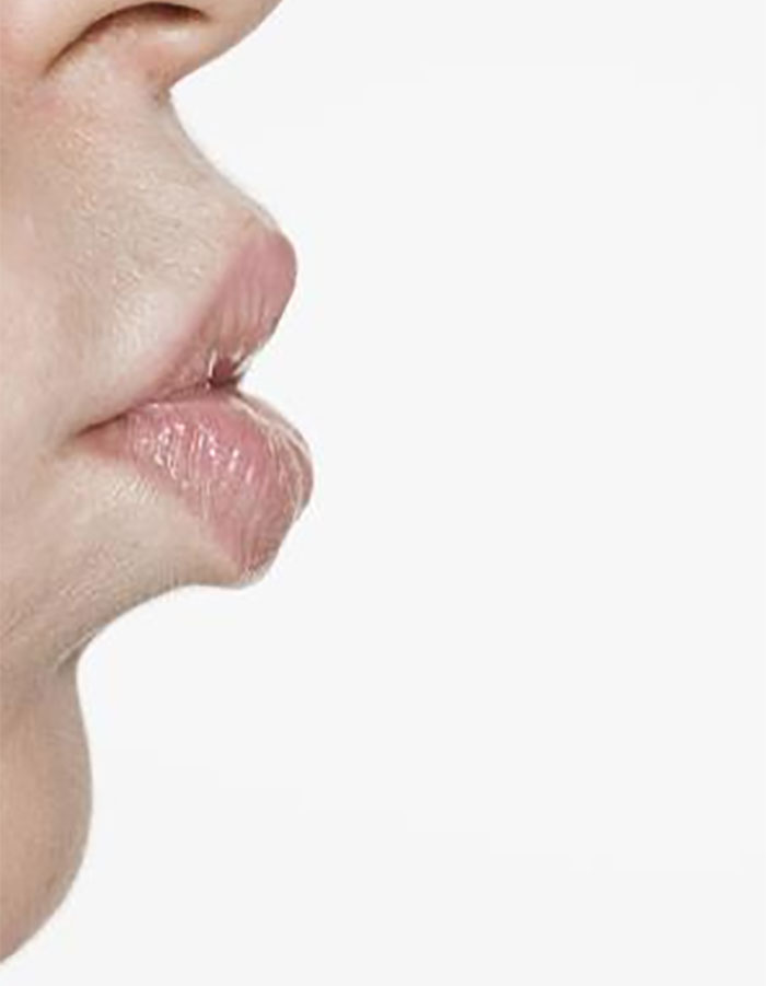  Imemistegevus „maasika“ tekitamisel võib kahjustada olulist arterit meie kaelas, misjärel tekib insulti põhjustav tromb. Arvatakse, et kõige hullem asi „maasika“ juures on see, kui lõhkenud veresoontest tekkinud väikest sinikat märkavad teised inimesed, kuid ilmselgelt võib see lõppeda ka halvemini. 